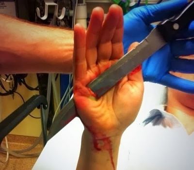 woman-hand-impalement-kitchen-knife-500x671-20-282-29.jpeg