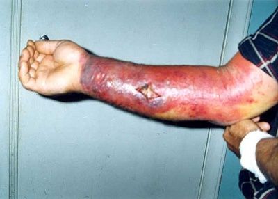 people_with_anthrax_001.jpg