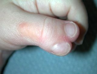 thumb-polydactyly.jpg