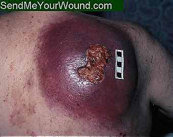 MelanomaBack hugezit.jpg