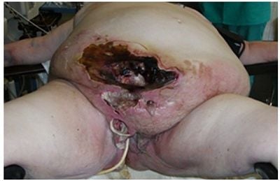 snuffx-dot-com-abdominal-fig1.jpg