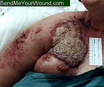 FungatingBreast boobrot.jpg