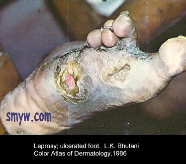 leprosy758.jpg