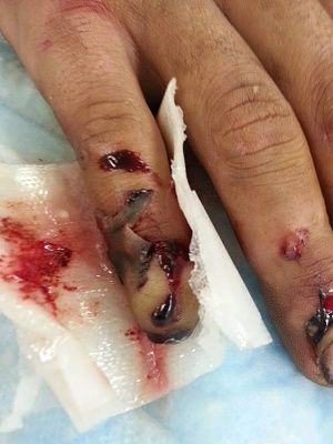 pully-20injury.jpg