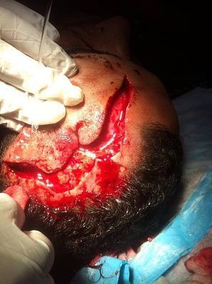 fell-20from-203rd-20floor-2c-20cut-20head-20open.jpg