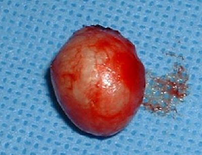 sebaceouscyst1.jpg