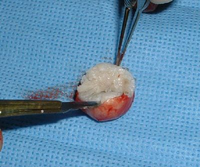 sebaceouscyst2.jpg