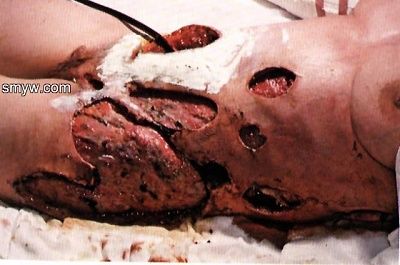 flesh_eating.jpg
