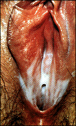 bacterial_vaginosis.gif