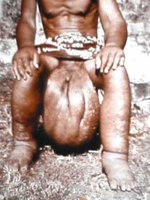 33_Elephantiasis.jpg