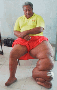 elephantiasis3.gif