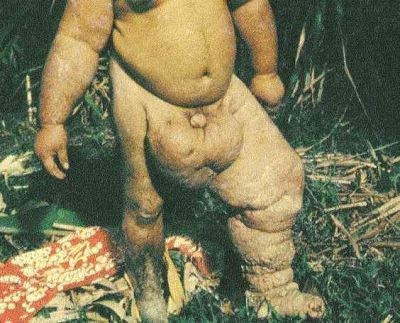 elephantiasis_2.jpg