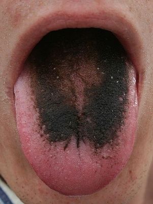 451px-black_tounge.jpg