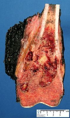 bone_osteosarcoma1_2resized.jpg