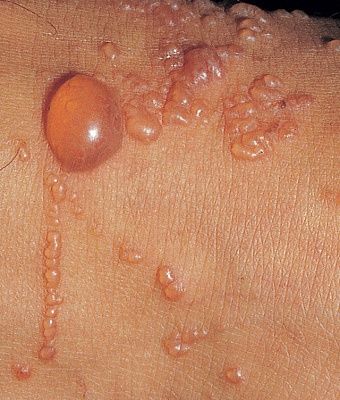 contact_dermatitis_rhus34.jpg