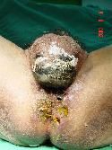 gangrene of the groin.jpg