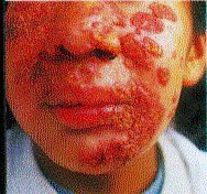 leishmaniasis.jpg