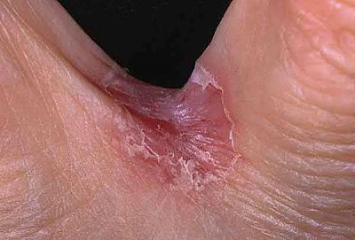tinea_yw04-01.jpg