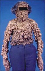 Neurofibromatosis.jpg