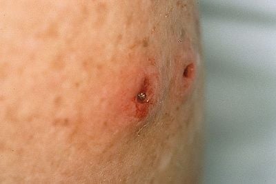 myiasis_2.jpg