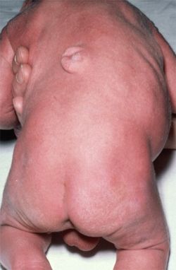 Name:  scoliosis2.jpg
Views: 5315
Size:  61.6 KB
