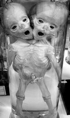conjoined-20fetus.jpg