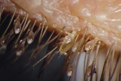 content-lice-eyelash.jpg