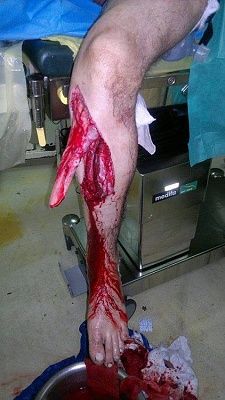 tibial-20open-20fracture.jpg