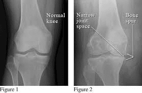 osteoarthritis.png