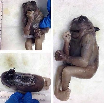20terminated-20fetus-20with-20anencephaly-20and-20clubbed-20feet.jpg