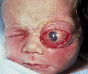 Name:  Cystic%20teratoma%20in%20a%20newborn.jpg
Views: 12819
Size:  24.6 KB