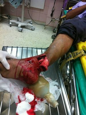 ankle-20injury-20-281-29.jpg