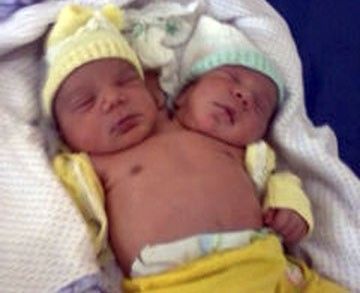 208594-a-brazillian-mother-has-given-birth-to-full-functioning-conjoined-twin.jpg