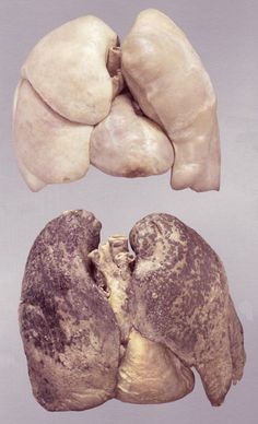 Healthy%20lungs%20%28top%29%20and%20smoker%E2%80%99s%20lungs%20%28bottom%29.jpg