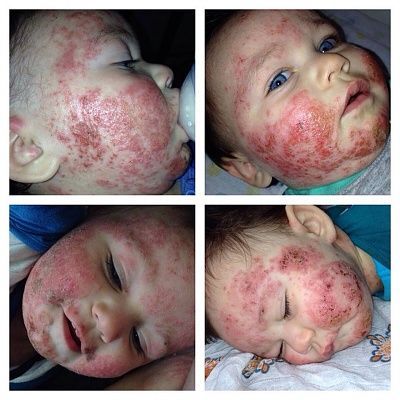 child_with_eczema.jpg