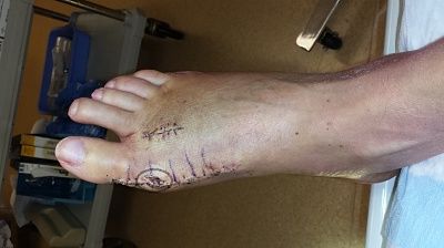 broken-20toe-20-.jpeg