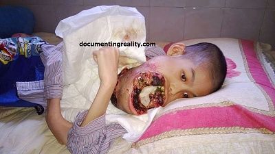 mouth-cancer11.jpg