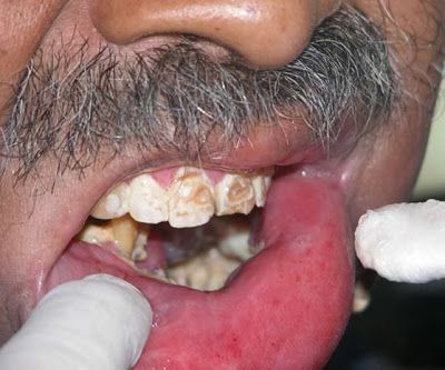 oral-cancer-myiasis02.jpg