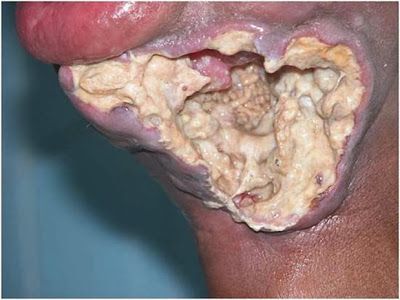 oral-cancer-myiasis03.jpg