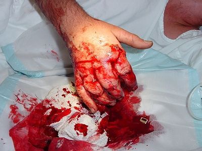 handlaceration.jpg