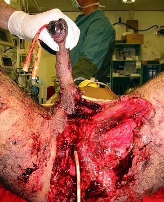 penis_surgery.jpg