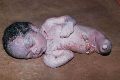 babies_with_birth_defects_002.jpg