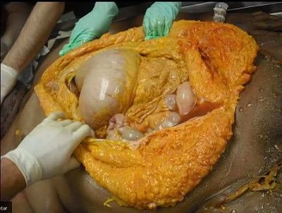 alcoholic-cirrhosis-1.jpg