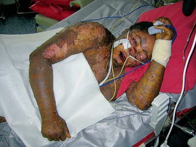 Name:  stevens-johnson-syndrome-7.jpg
Views: 2062
Size:  35.4 KB