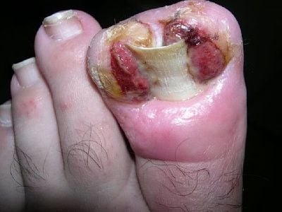 sfcingrown2.jpg
