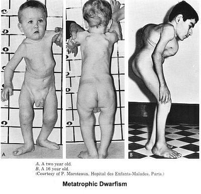 metatrophicdwarf.jpg