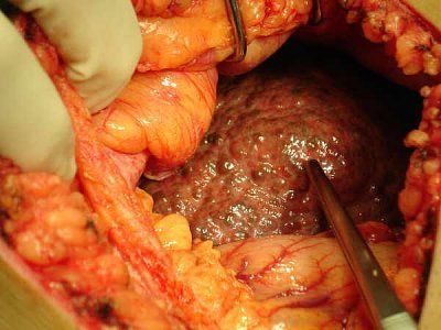 cirrhosissurgery.jpg