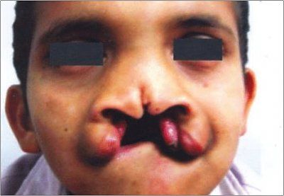 indianjophthalmol_2007_55_2_162_30725_2.jpg