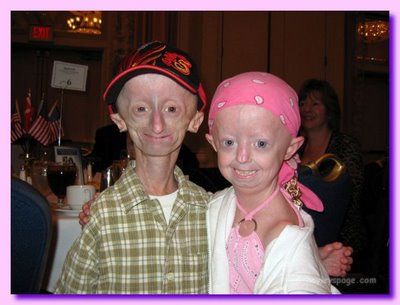 progeria.jpg