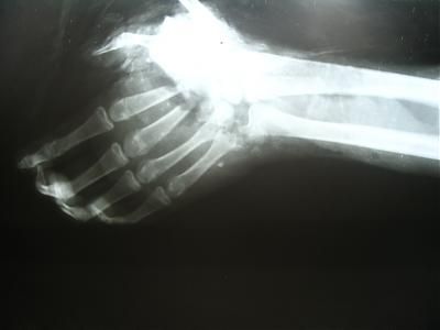 Name:  fuckeduphandxray.jpg
Views: 228
Size:  9.1 KB